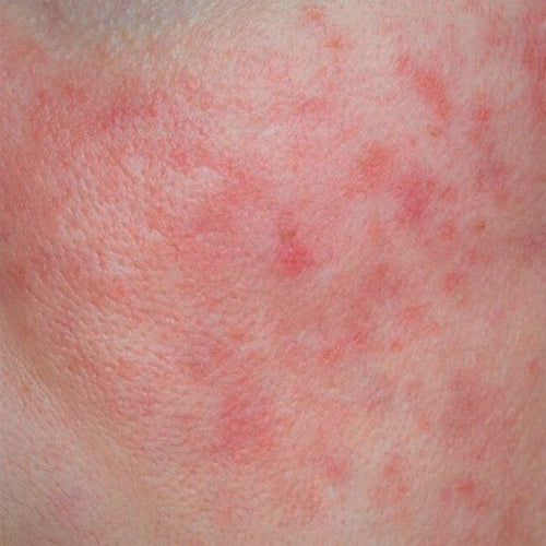 Dry Skin
