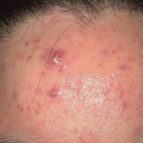 Skin breakouts