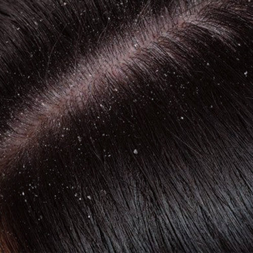 itchy scalp